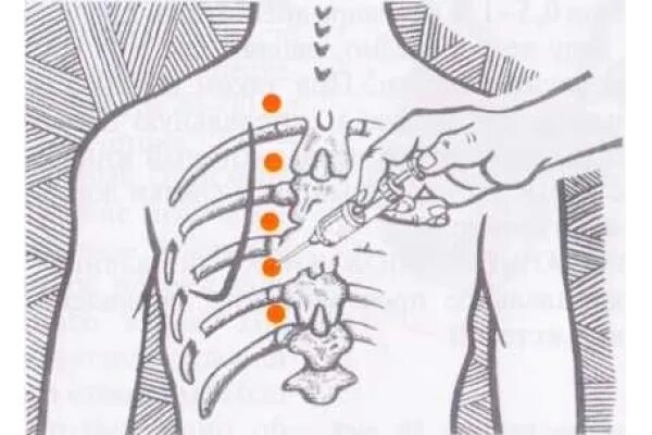 Межреберная блокада. Паравертебральная новокаиновая блокада показания. Паравертебральная блокада грудного отдела позвоночника техника. Межреберная паравертебральная блокада. Паравертебральная блокада поясничного отдела позвоночника.