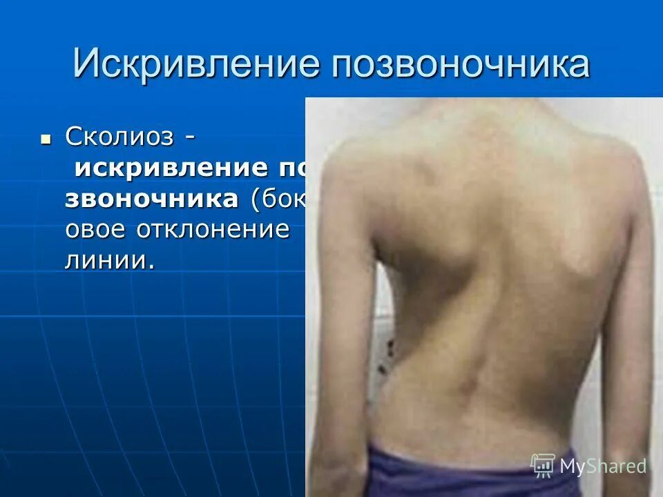 Искривление вариант. Кифоз грудного отдела позвоночника 4 степени. Искривление позвоночника в бок. Сутулость. Кифоз позвоночника 4 степени.