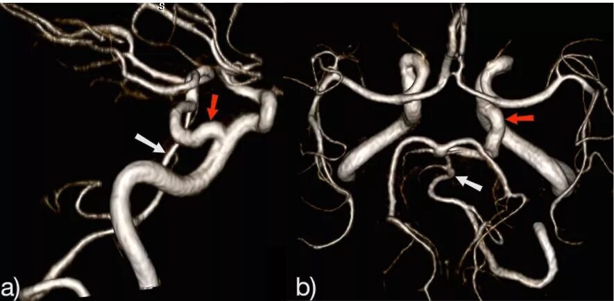 Гипоплазия червя. Аневризма сонной артерии кт. Аневризма базилярной артерии. Блистерная аневризма сонной артерии. Персистирующая тригеминальная артерия мрт.