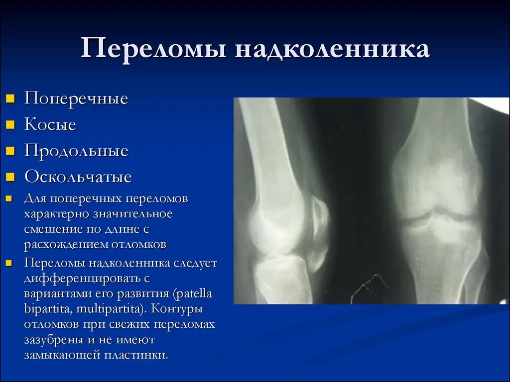 Хондральный перелом надколенника. Краевой вертикальный перелом надколенника. Краевой перелом Нижнего полюса надколенника. Закрытый краевой перелом надколенника.