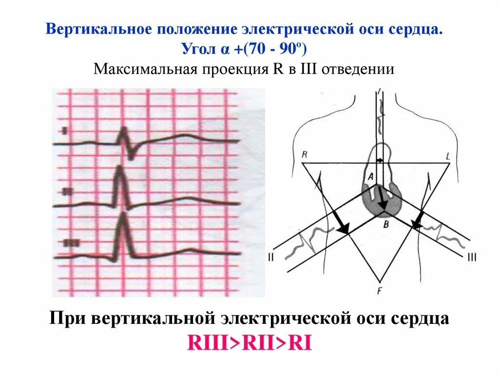 Горизонтальное положение это как. Вертикальное положение ЭОС на ЭКГ. Вертикальное направление электрической оси сердца. Вертикальное положение оси сердца. ЭКГ при вертикальной ЭОС ЭКГ.