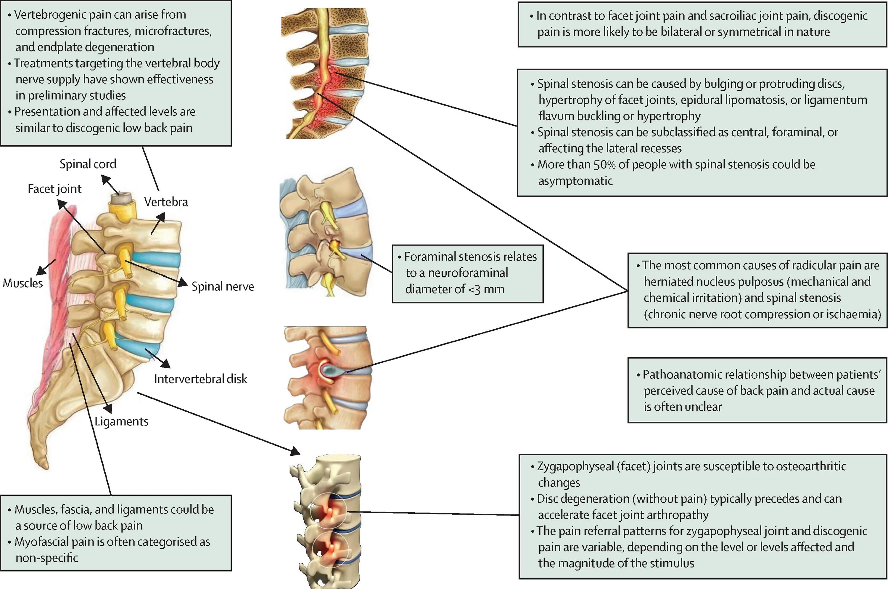 Синдром боли в спине. Lower back muscles. Causes of back Pain. Анатомия боли. Pain in the Lumbar.