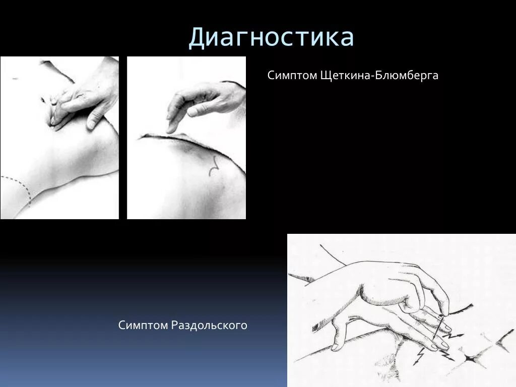 Щеткина блюмберга при аппендиците. Щеткина Блюмберга Ровзинга. Щеткина-Блюмберга, Раздольского,. Симптом Менделя и Щеткина-Блюмберга. Симптом Щеткина Блюмберга.