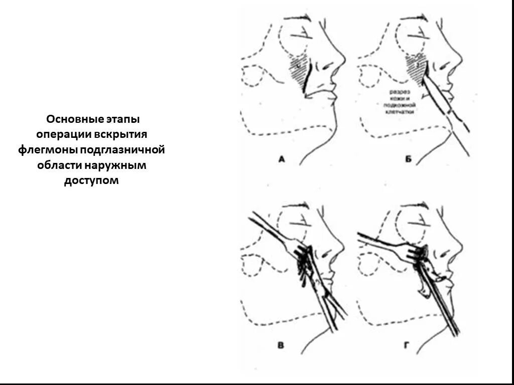 Операция вскрытия абсцесса и флегмоны подглазничной области.. Флегмона скуловой области операция. Разрез при флегмоне подглазничной области. Вскрытие флегмон челюстно-лицевой области. Операция абсцесс шеи