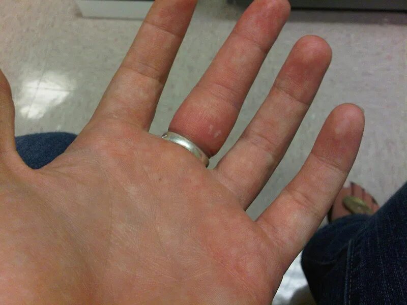 Тату обручальные кольца белые. Аллергия на пальце от кольца. Кольцо на безымянном пальце. Кольцо на пальце. Кольцо на безымянном пальце.