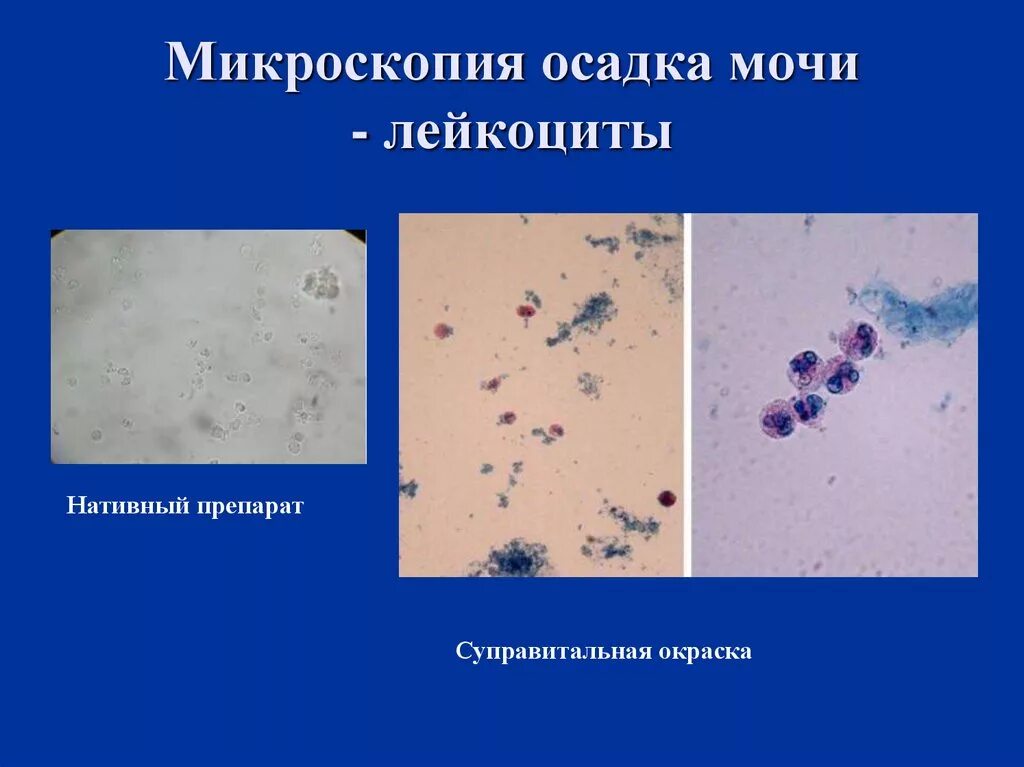 Лейкоциты в моче микроскопия осадка. Микроскопия мочи. Микроскопия окрашенного осадка мочи. Микроскопия мочи лейкоциты.