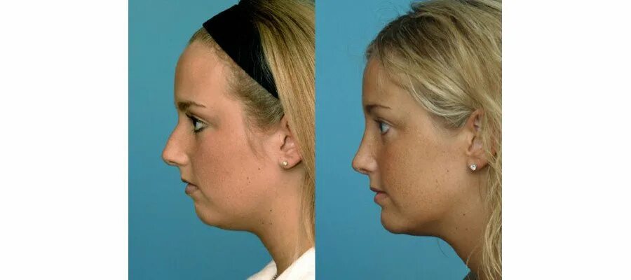 аденоидное лицо до и после