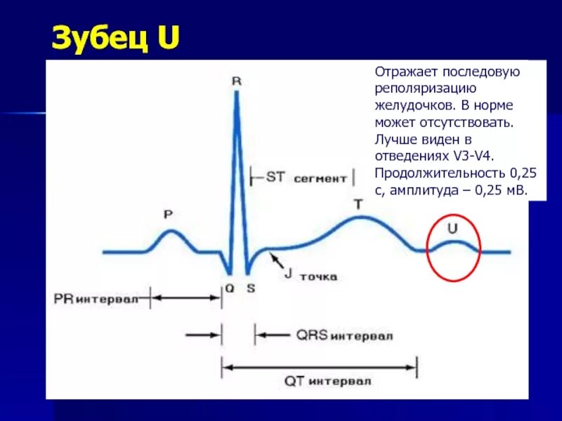 Зубец р. Зубец u на экг. зубец п на экг в норме. зубцов qrs в отведении v4 в норме. зубец p на экг норма.