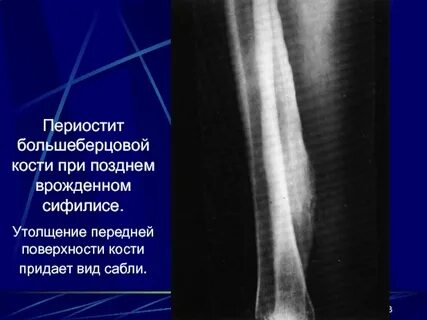 Мкб 10 большеберцовой кости
