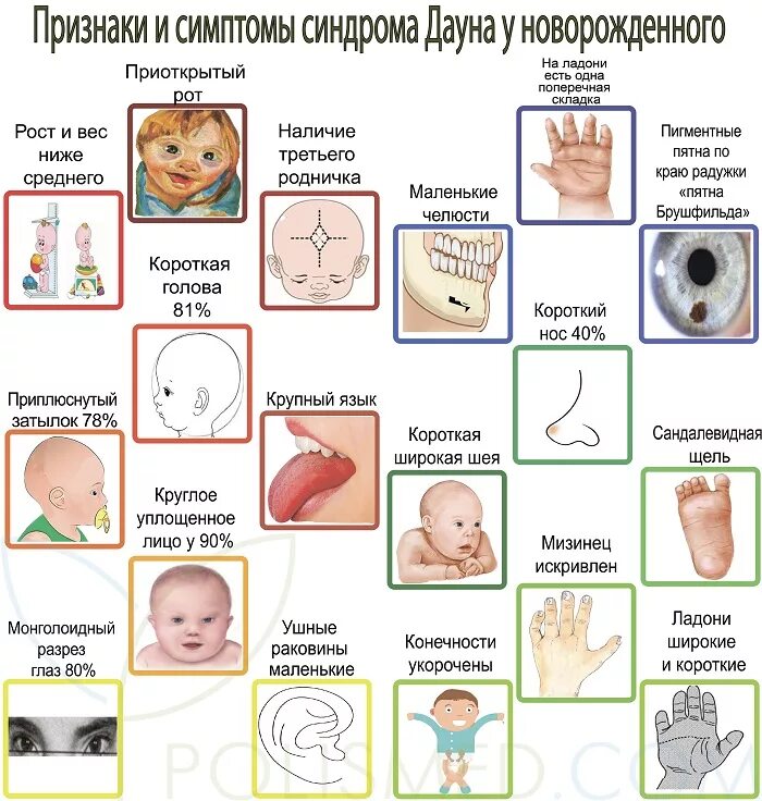 Узнать детей человека. Внешние проявления синдрома Дауна. Внешние признаки синдрома Дауна у новорожденных. Синдром Дауна минимальные диагностические признаки. Характерные признаки проявления болезни синдрома Дауна.