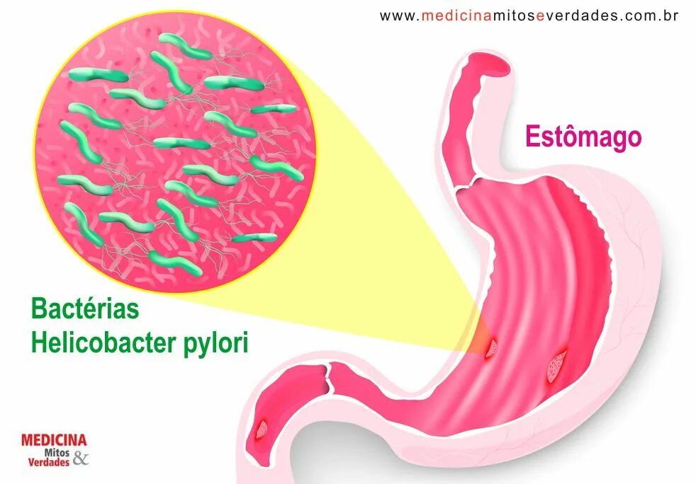 Поверхностный неатрофический гастрит что это такое. Язвенная болезнь желудка Helicobacter. Хеликобактер пилори язва. Язва желудка хеликобактер.