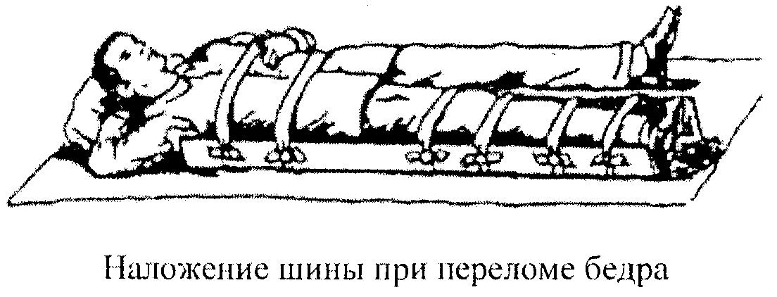 Техника наложения шин при переломах. Шина Дитерихса при переломе бедра. Перелом бедра шина Дитерихса. Наложение шины Крамера при переломе бедренной кости. Шинирование при переломе бедра.