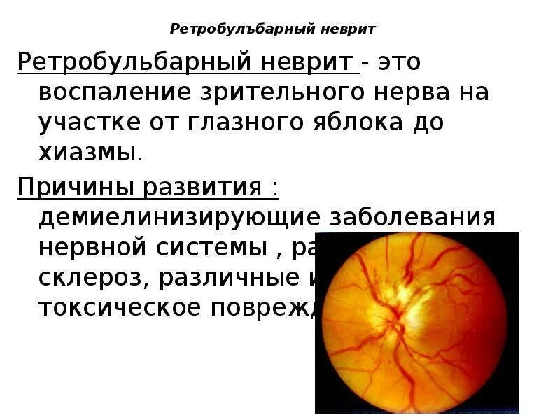 Лечение глазного нерва. Ретробульбарный неврит зрительного нерва. Ретробульбарный неврит зрительного нерва симптомы. Ретробульбарный неврит зрительного нерва офтальмология. Неврит зрительного нерва препараты.