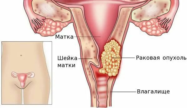 Как выглядит рак шейки матки ПРИЧИНЫ РАКА ШЕЙКИ МАТКИ