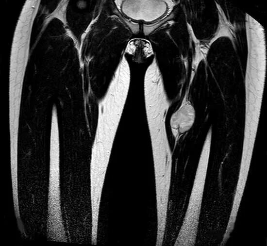 Мягких тканей бедра. Разрыв двуглавой мышцы бедра мрт. Мягких тканей бедра. Гематома мягких тканей бедра мрт. Мягких тканей бедра.