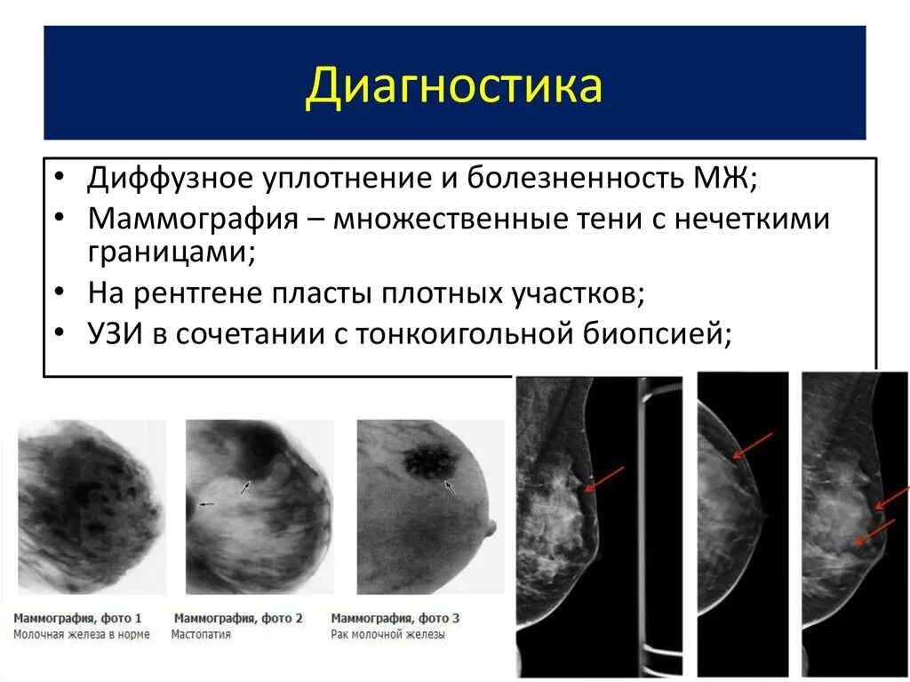 Фиброзно кистозная мастопатия маммограмма. Кистозная мастопатия маммография. Диффузная фиброзно-кистозная мастопатия маммограмма. Фиброзно-кистозная мастопатия молочных желез на маммографии.