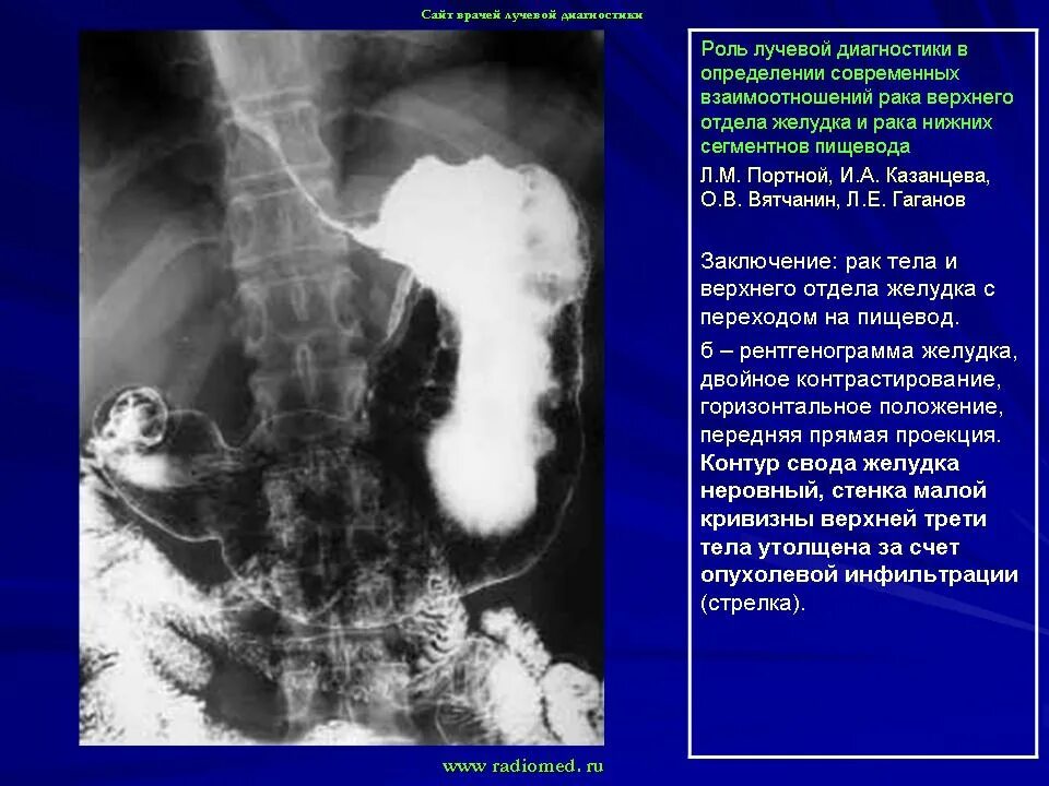 Кт при опухоли пищевода. Опухоль пищевода на СКТ. Компьютерная и спиральная томография пищевода. Кт пищевода и желудка