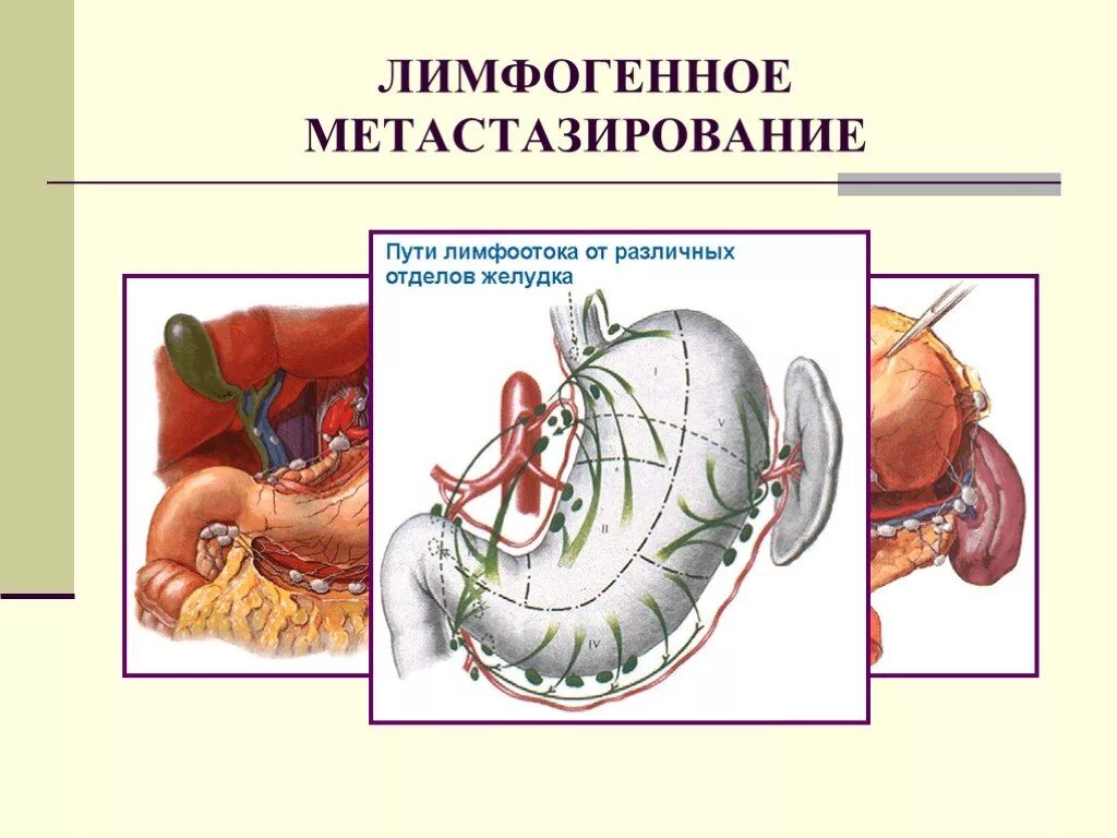 Пути метастазирования рака. Лимфогенное метастазирование. Лимфогенный путь метастазирования. Лимфогенный путь метастазирования опухоли. Лимфогенный путь распространения метастаз.