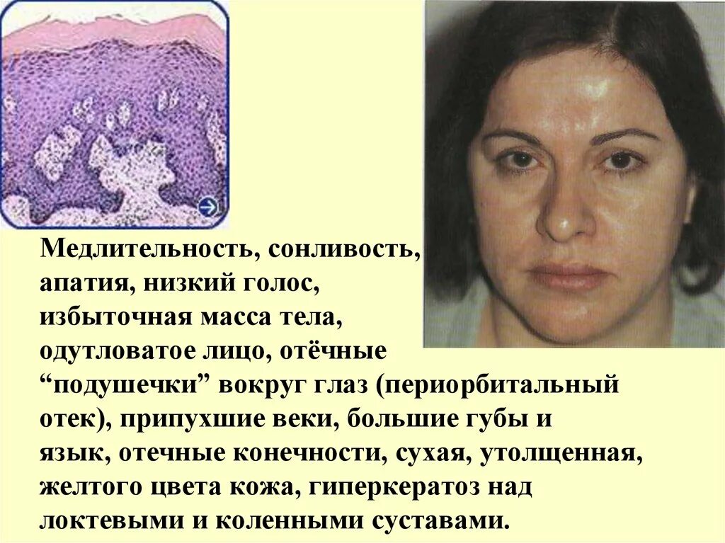 Отечные мешки под глазами. Отек век по утрам причины у женщин. Припухлость над глазом. Отечные мешки под глазами. Мешки под глазами.