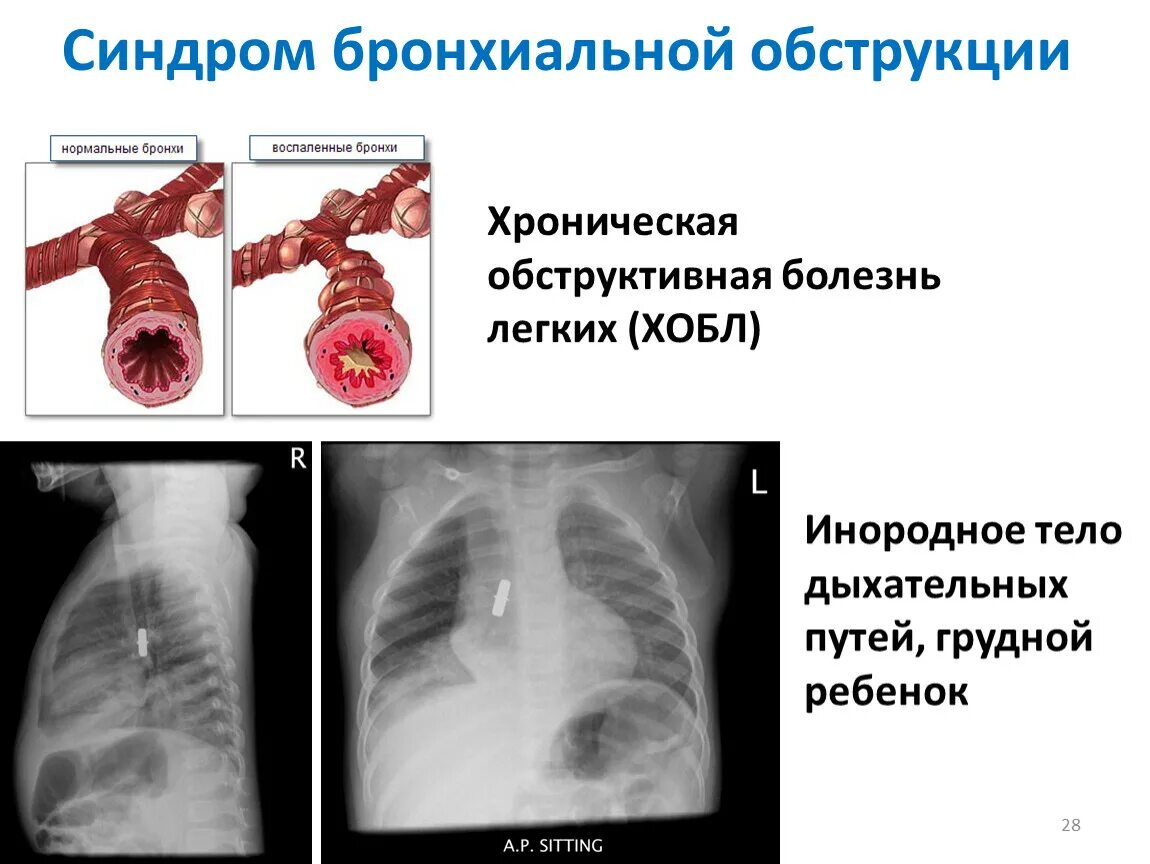 Синдром нарушения бронхиальной проходимости рентген. Хронический бронхит бронхообструктивный синдром. Синдром бронхиальной обструкции рентген. Синдром бронхиальной обструкции при бронхиальной астме. Острое поражение легких