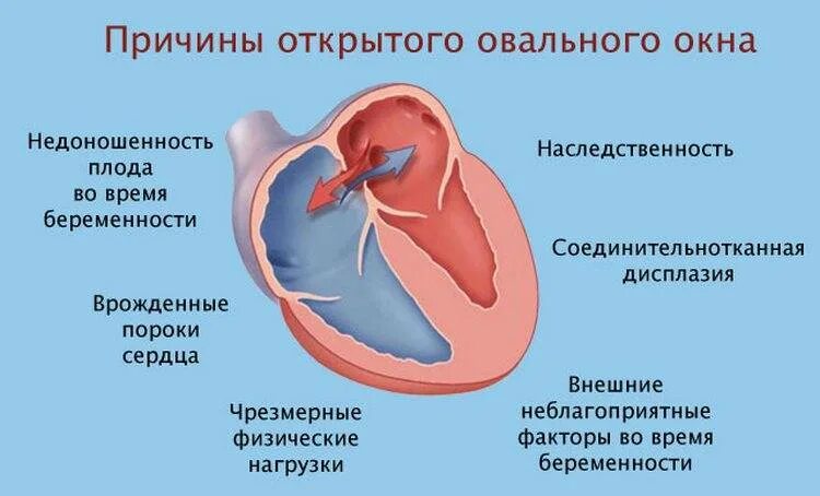 1 3 окно в сердце. Открытое овальное окно 6 мм у грудничка. Овальное окно в сердце новорожденных располагается. Функционирующее открытое овальное окно у новорожденных. Открытое овальное окно - 3,6 мм у новорожденного.