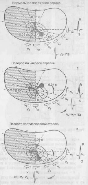 Поворот сердца против часовой стрелки. Поворот по часовой стрелки ЭКГ. Поворот сердца по продольной оси. Поворот сердца вокруг продольной оси. Поворот правым желудочком вперед