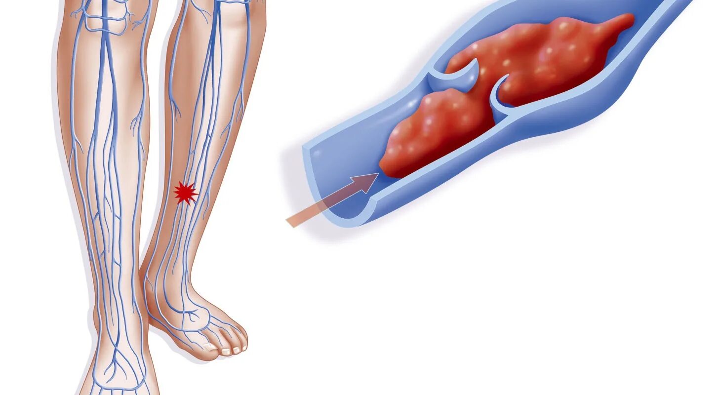 Болезненные вены. Тромбофлебит нижних конечностей клиника. Флебит тромбофлебит глубоких вен. Трофическая язва варикозная болезнь вен нижних конечностей. Венозный тромбоз глубоких вен нижних конечностей.