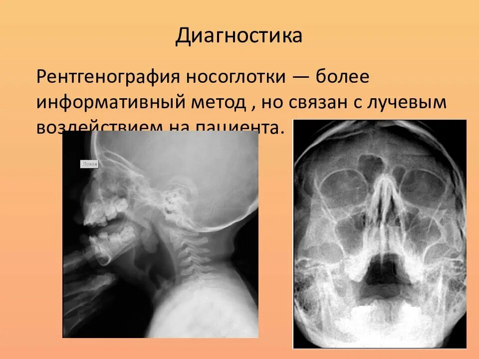 Носоглотка в норме