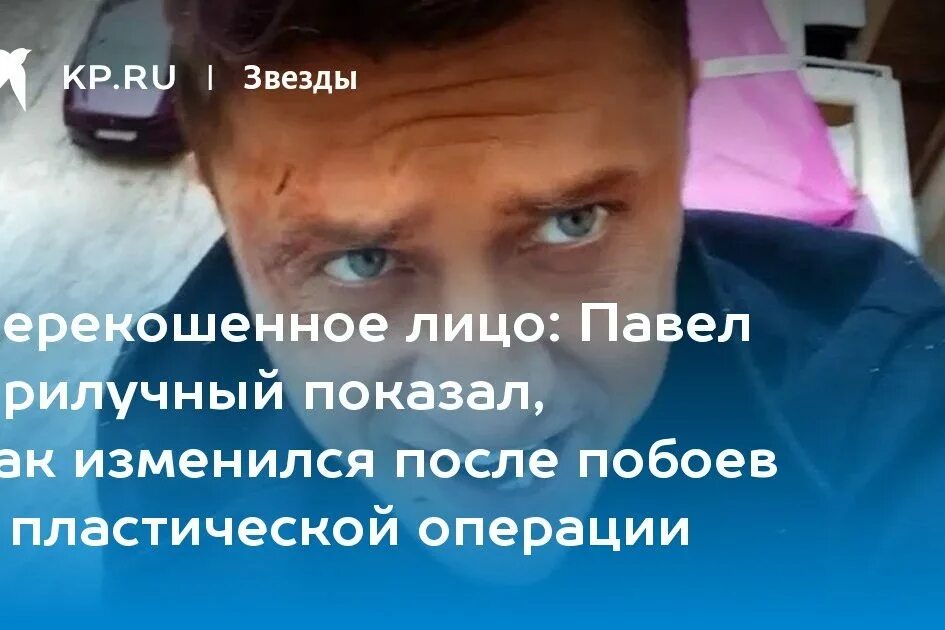 Прилучный 2021. Лицо прилучного после операции. Прилучным после операции. Российского актера избил. Прилучным после операции.