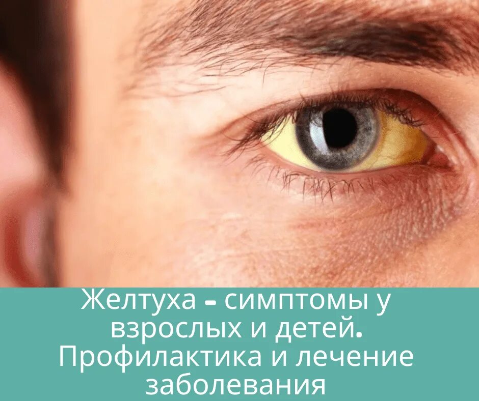 Проявления механической желтухи. Желтуха причины. Желтуха у взрослых симптомы. Клиническая картина желтухи. Признаки желтухи у взрослых.