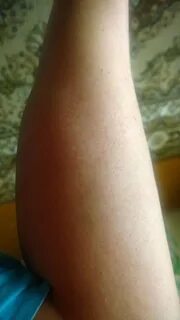 Солярий чешется кожа