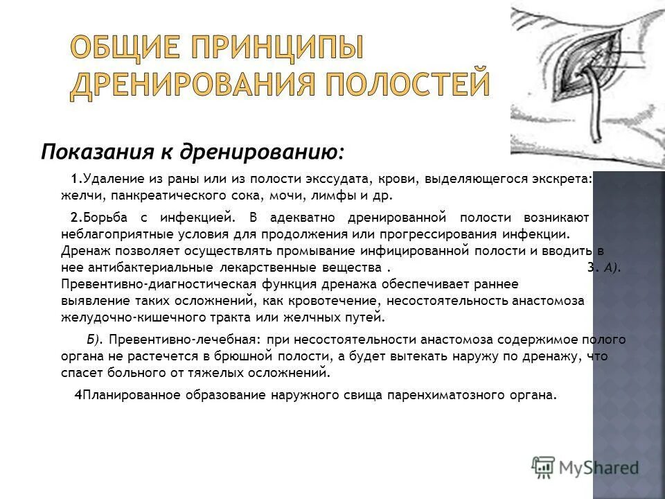 Дренирование раны и полостей. Дренирование раны и полостей