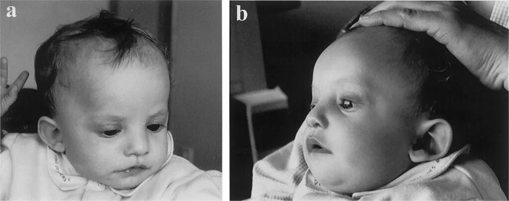 Синдром вольфа хиршхорна клинические признаки. Синдром вольхва шиошорна. Синдром вольфа-хишхорна. Хиршхорна синдром вольфа хиршхорна. Кариотип вольфа-хиршхорна.