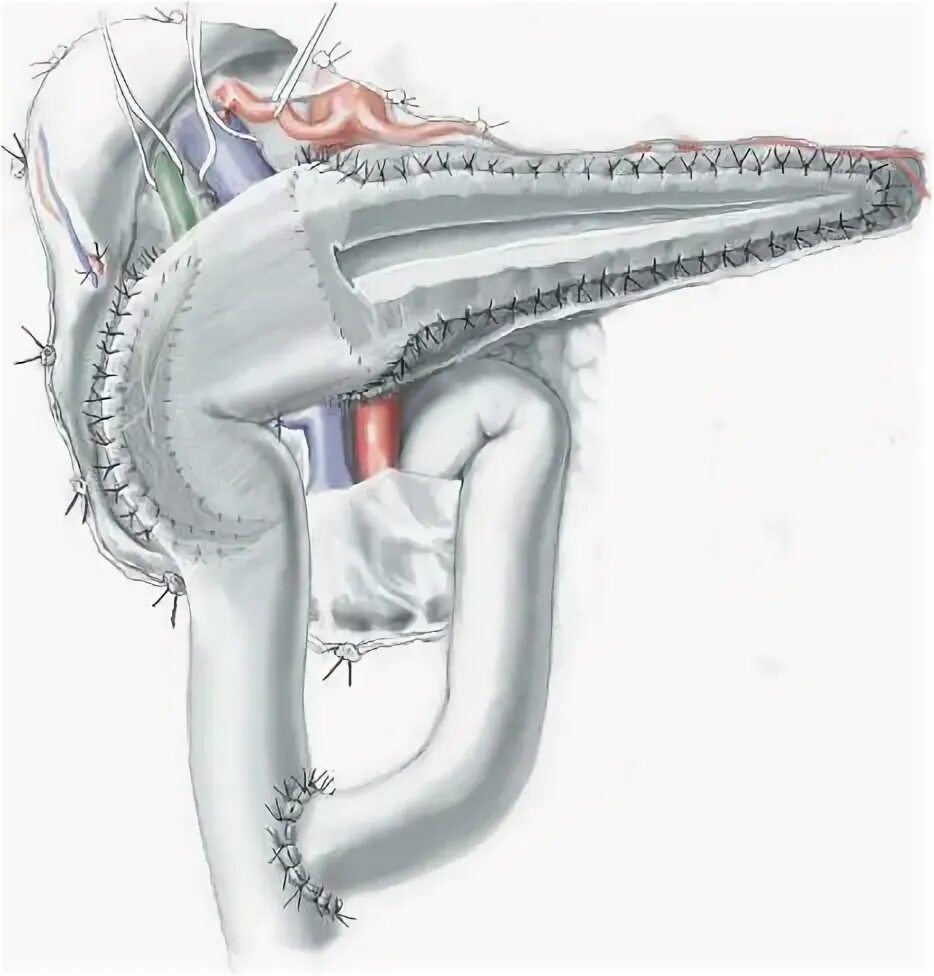 Операция Бегера на поджелудочной железе. Корпорокаудальная резекция поджелудочной железы. Резекция поджелудочной железы Фрея. Панкреатит операцию делают