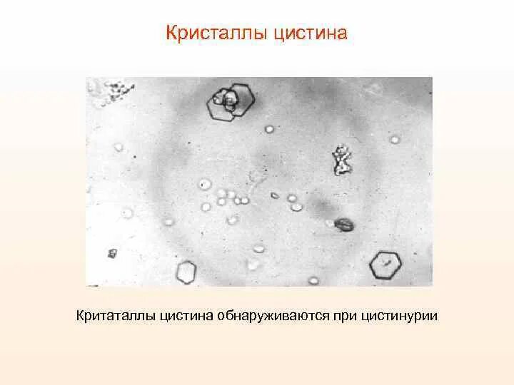 Повышен цистин в моче. Кристаллы цистина. Кристаллы мочи цистин. Цистин в моче. Кристаллы цистина в моче животного.