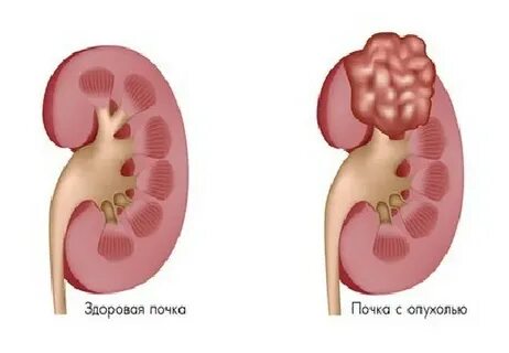 Пиелонефрит у женщин после
