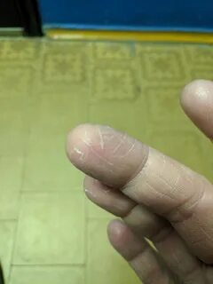 Палец без подушечки