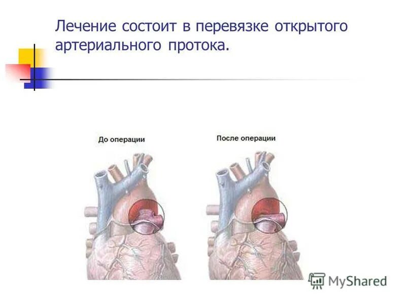 Открытый артериальный проток хирургическое лечение. Оап гемодинамика схема. Впс открытый артериальный проток. Открытый артериальный (боталлов) проток. Открытый артериальный проток лечение.