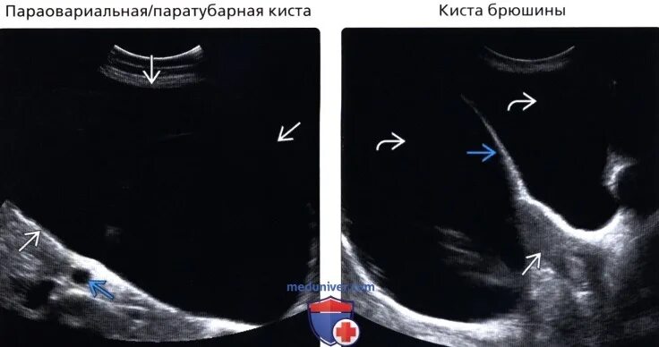 Надо ли удалять параовариальную кисту. УЗИ признаки параовариальной кисты. Параовариальная киста яичника. Параовариальные кисты яичников.