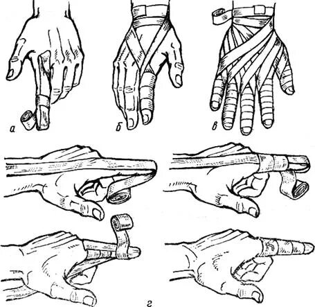 Повязка на кисть алгоритм. Рыцарская перчатка повязка алгоритм наложения. Бинтование Рыцарская перчатка. Рыцарская перчатка перевязка. Наложить повязку Рыцарская перчатка.