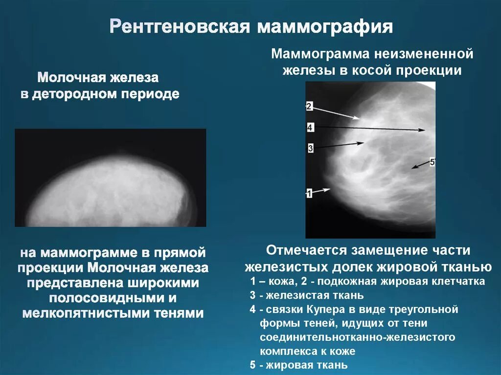 Анализ маммографии. Квадранты молочной железы на маммографии. Нормальная рентгеноанатомия молочной железы. Анатомия молочной железы маммография. Рентгенологическая маммография.