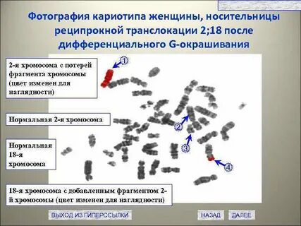 Кариотип транслокации