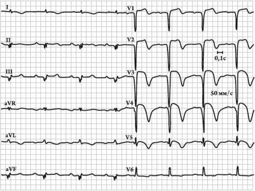 Изменение зубца q. Зубец q на ЭКГ при инфаркте. Q инфаркт миокарда на ЭКГ. ЭКГ при q инфаркте миокарда. Инфаркт миокарда зубцы на ЭКГ.