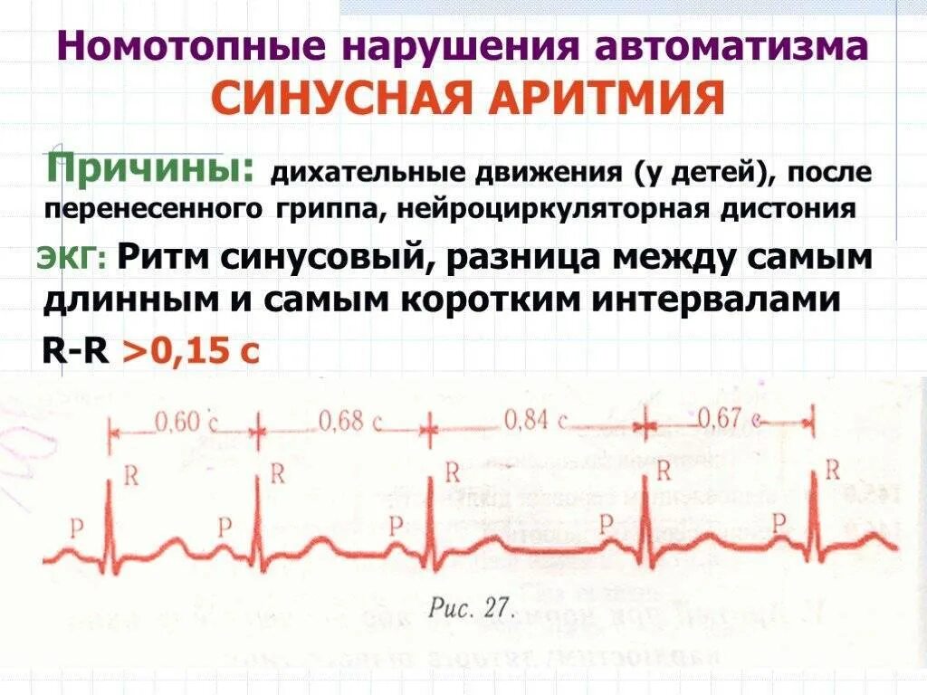 Синусовый ритм у подростка