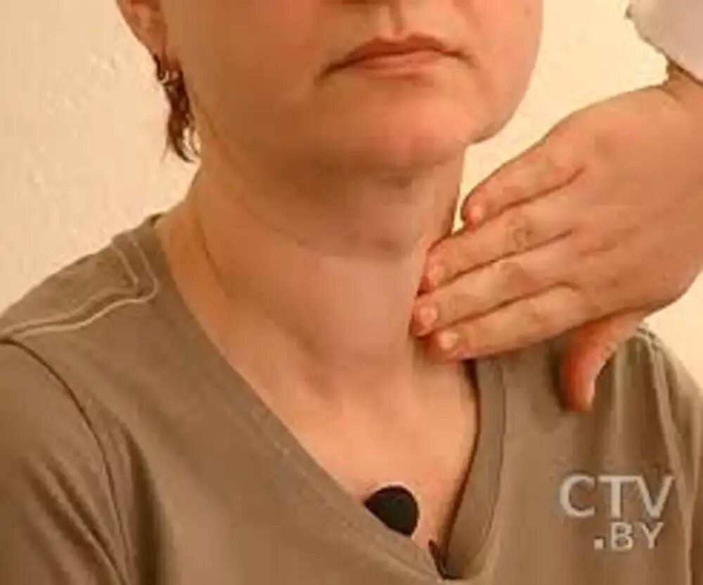 Заболевания при гипофункции щитовидной железы. Отек шеи при щитовидке. Гипотиреоз массаж можно ли. Артериальная гипертензия при заболеваниях щитовидной железы. Снижена функция щитовидной железы.