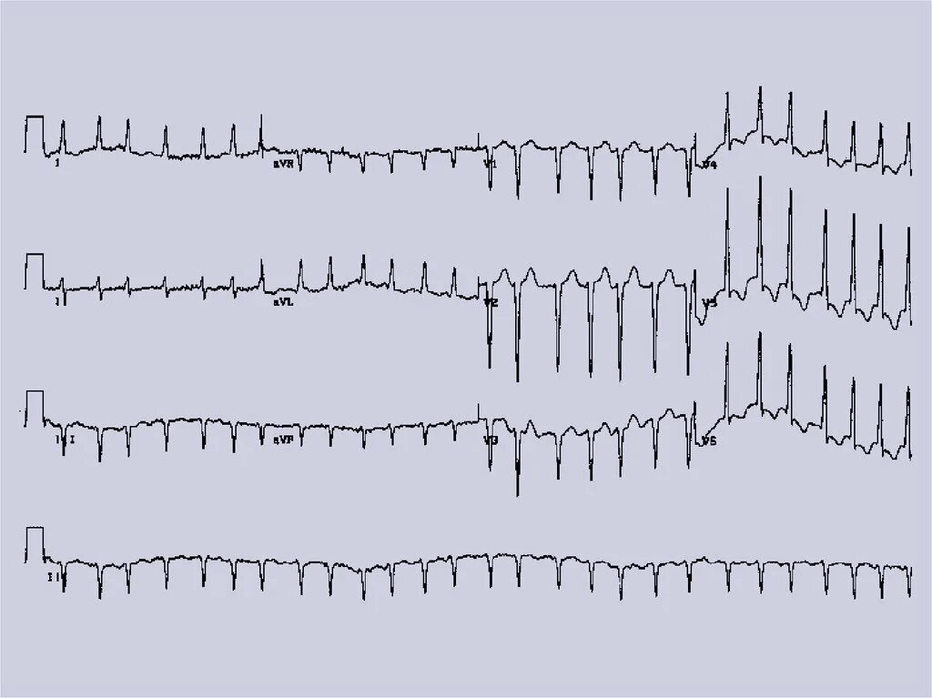 ЭКГ. Тахисистолия. Тахикардия и тахисистолия. Rapid ЭКГ.