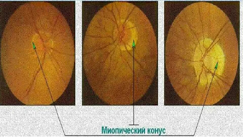 Миопический конус глазное дно. Узкий миопический конус глазное дно. Стафилома диска зрительного нерва.