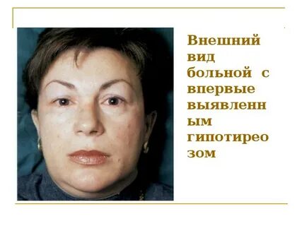 Гипотериоз после лечения