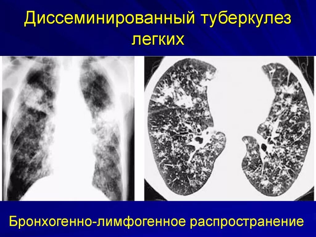 Очаговое поражение легких. Хронический диссеминированный туберкулез кт. Лимфогенно диссеминированный туберкулез рентген. Подострый диссеминированный туберкулез кт. Милиарный диссеминированный туберкулез рентген.