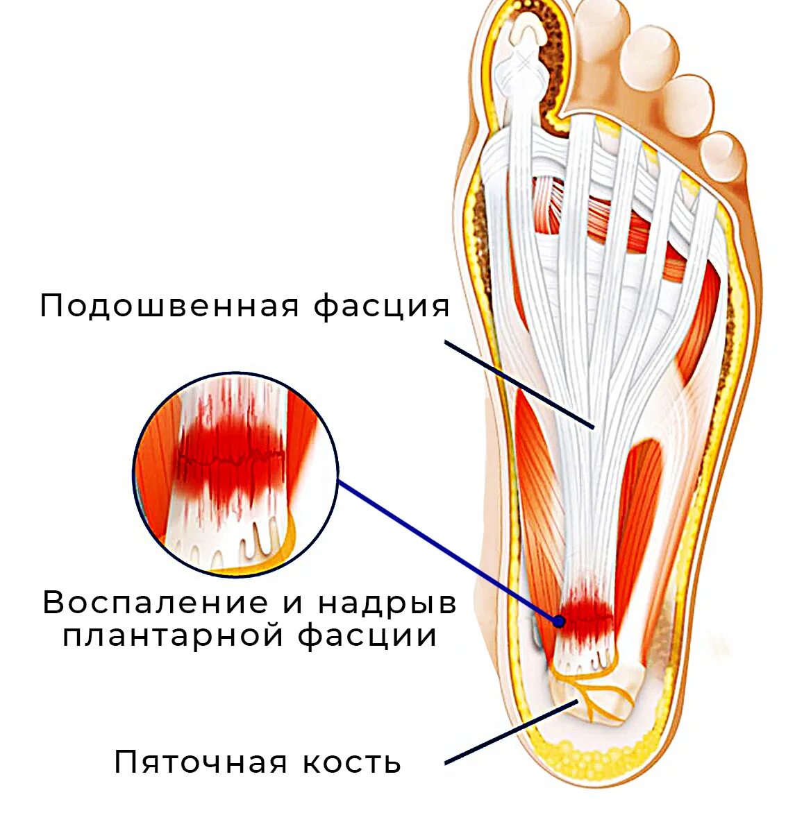 Боль сбоку пятки с внутренней стороны. Болит внутренняя часть пятки сбоку. Болит подошва пятки